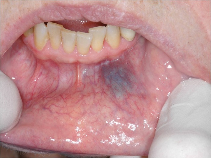 Benign Oral Lesions 113