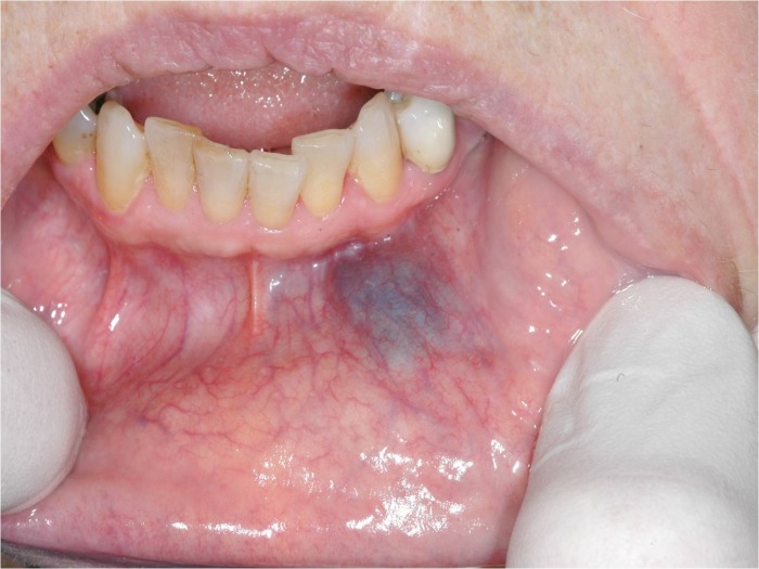 Benign Oral Lesions 14