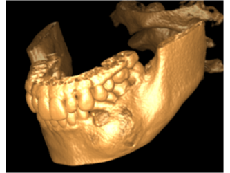 Cysts of the jaw - Dr. Khaled Amin Tarboush D.D.S, MS, C.A 